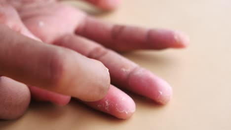 Close-up-of-dry-cracked-skin-of-a-mens-hand-,