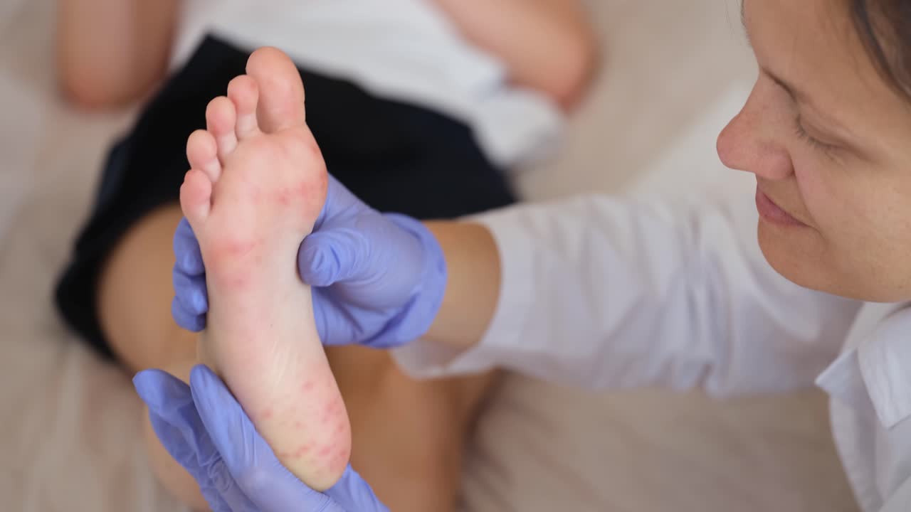 Doctor examines foot rash