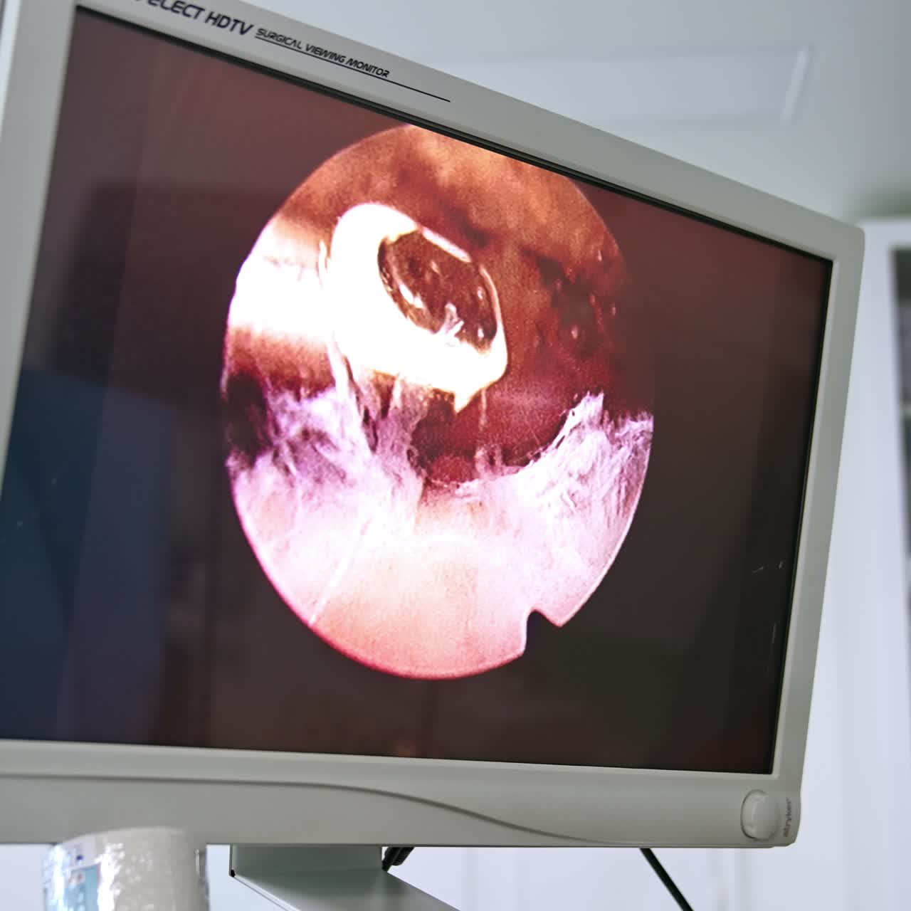 Medical tool moving inside the surgical cut of a patient. Screen shoving the operational procedure from inside. Close up
