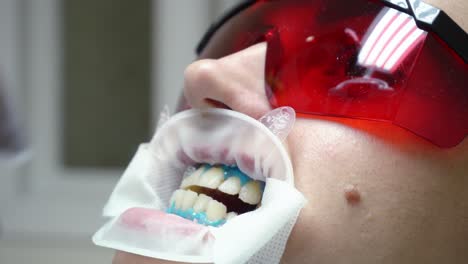 Mujer-Joven-Con-Un-Expansor-En-La-Boca-En-La-Clínica-Dental.-Aplicación-De-Gel-Blanqueador-Protector-En-Los-Dientes.-Consultorio-Dental-Moderno.-Filmado-En-4k