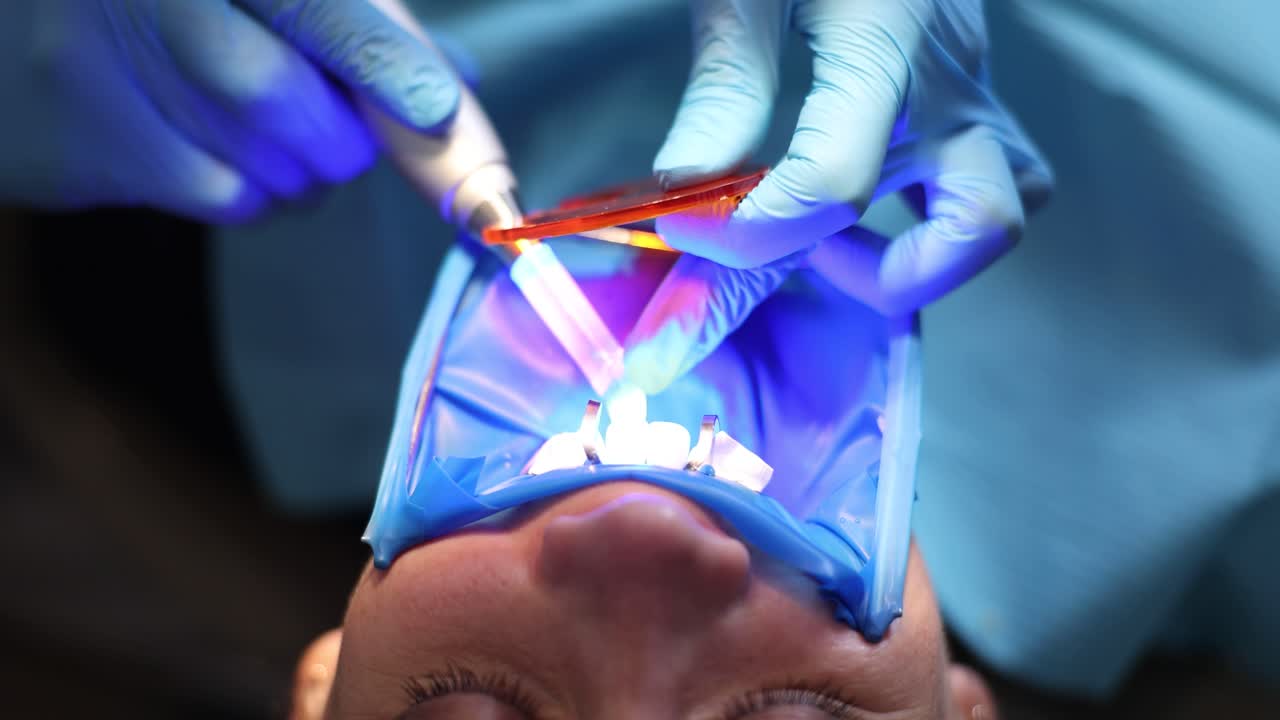 Procedura odontoiatrica con diga di gomma e riempimento composito