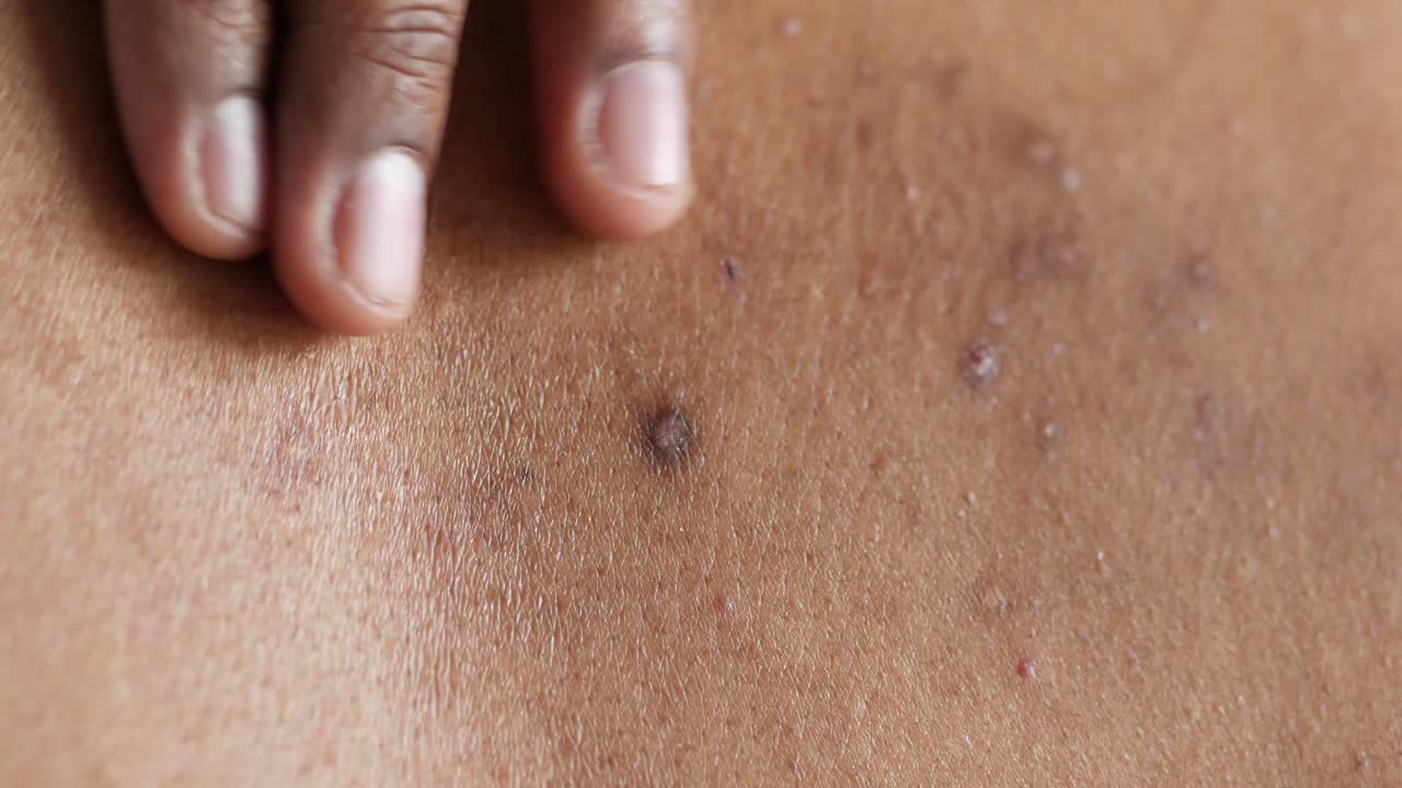 얼룩이 있는 등에 있는 피부의 클로즈업