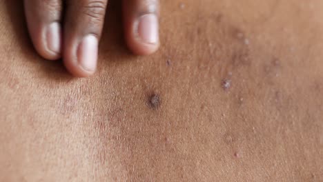 primer plano de la piel en la espalda con manchas