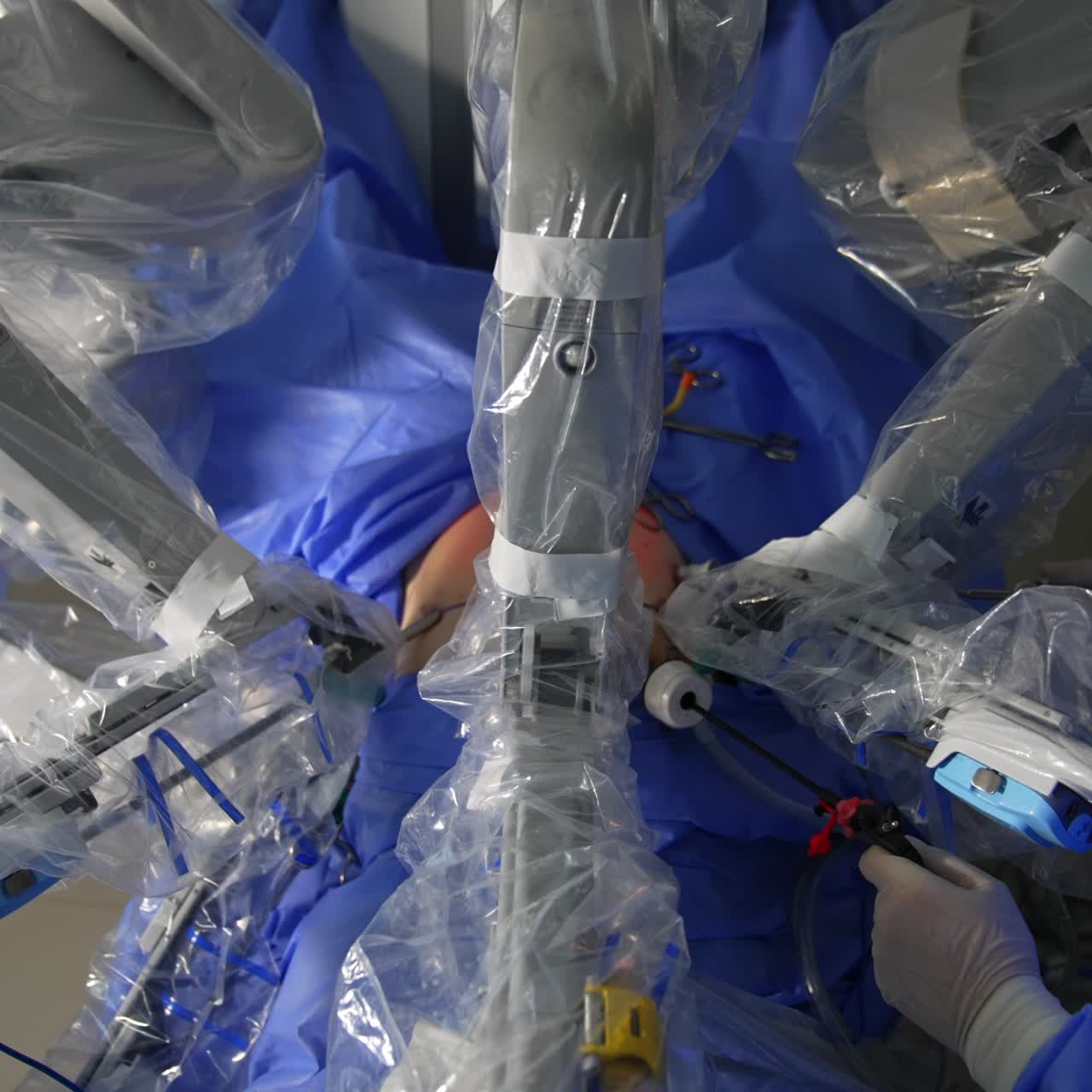 Technological robotic arms input into the abdomen of a patient. Professional doctor controlling the procedure on the monitor. View from top