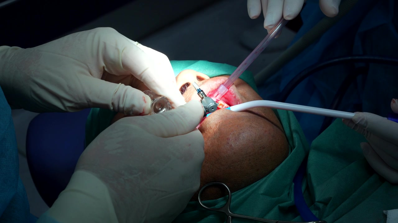 Patient with a dental implant and doctor trying to find the best screw for it. Close up shot