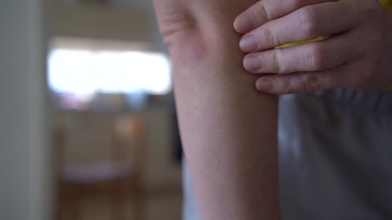 여성이 팔꿈치 부위에서 가려움증을 느끼고, 벌레가 습니다.