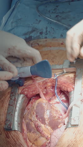 el cirujano retira el dispositivo estabilizador. el equipo quirúrgico realiza una cirugía complicada en el corazón conectando los vasos injertados a la arteria coronaria en la sala de operaciones.