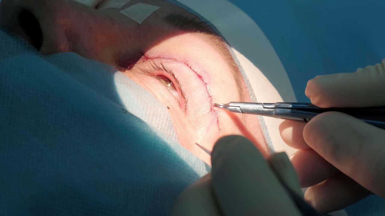 블레파로플라스티 (blepharoplasty) 는 눈 영역의 재생과 변형에 초점을 맞춘 성형수술입니다.