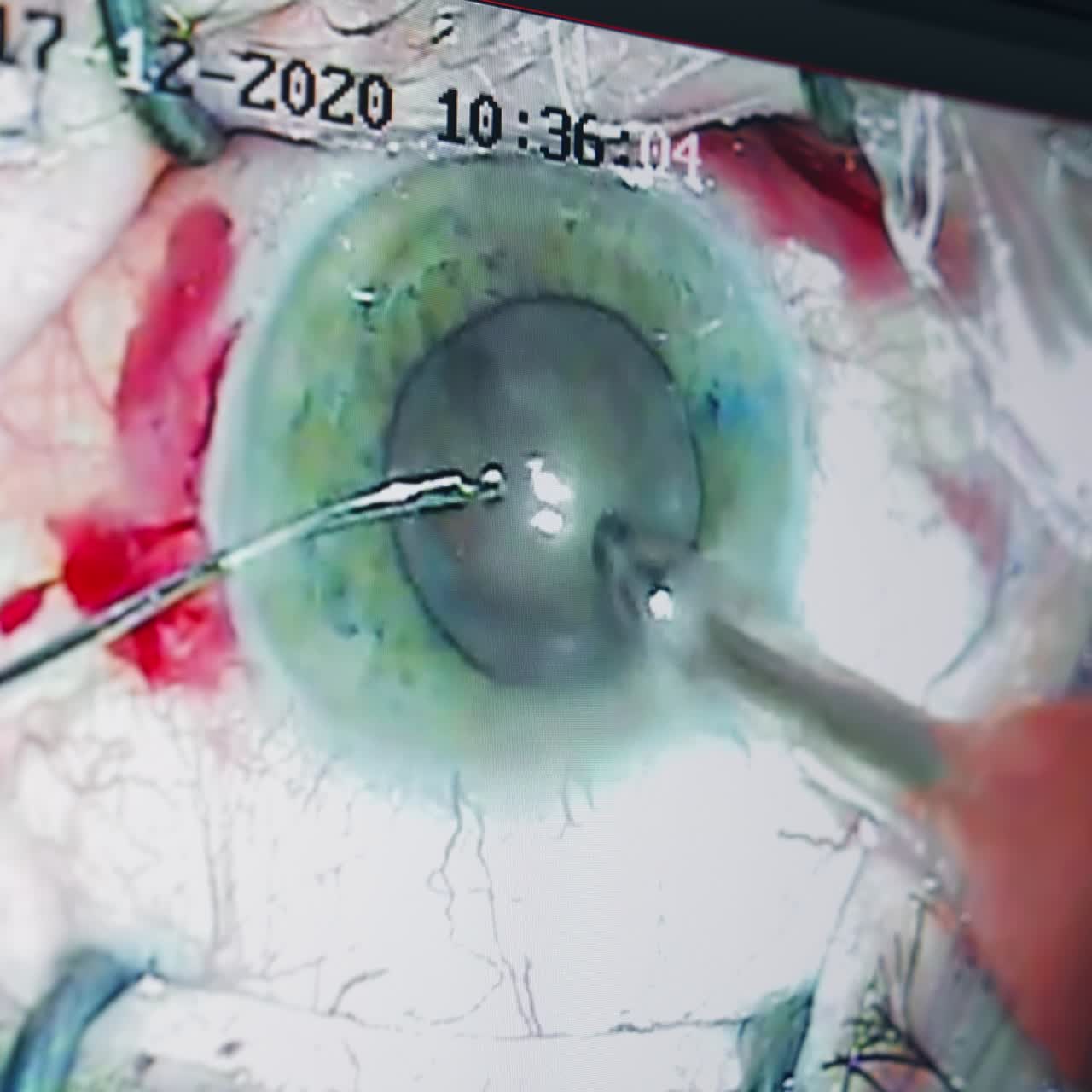 Eye with ophtalmology surgery tools. Surgery operation in modern clinic. Vision correction surgical treatment
