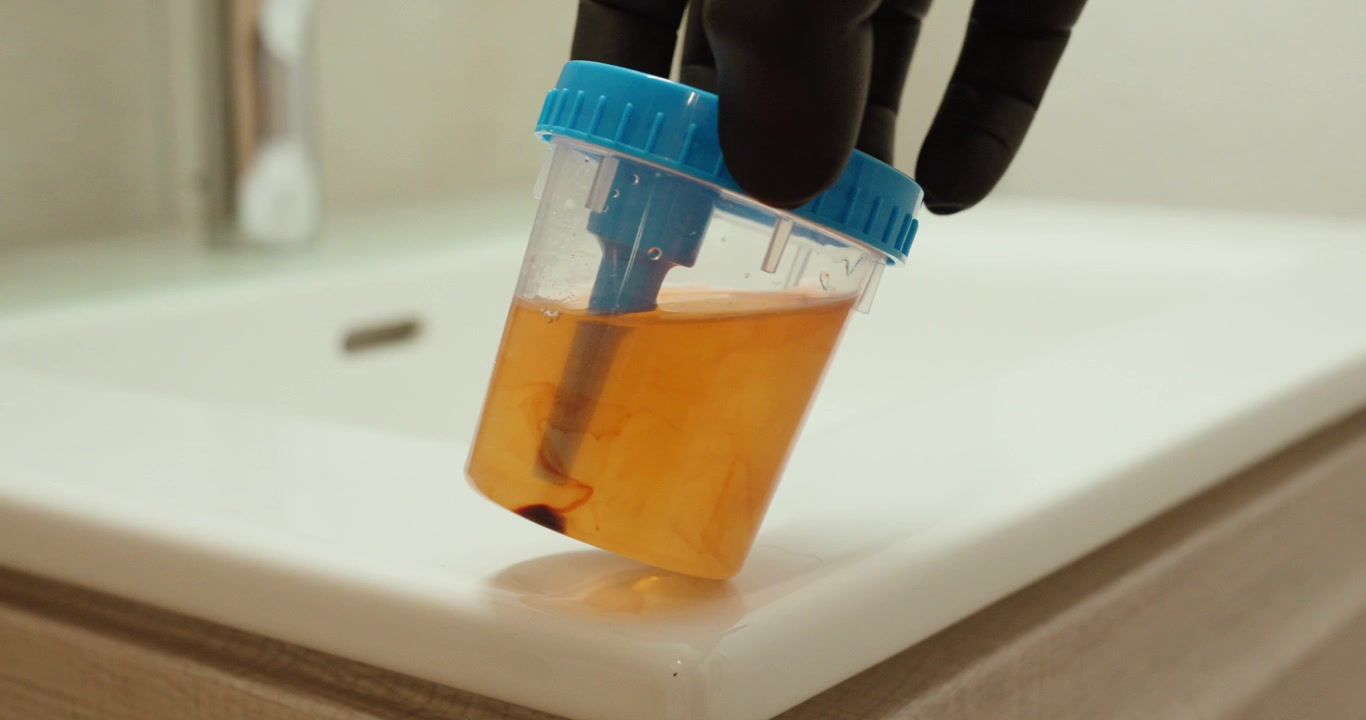 Close-up of a urine sample with visible blood traces, representing medical warning signs and diagnostic testing.