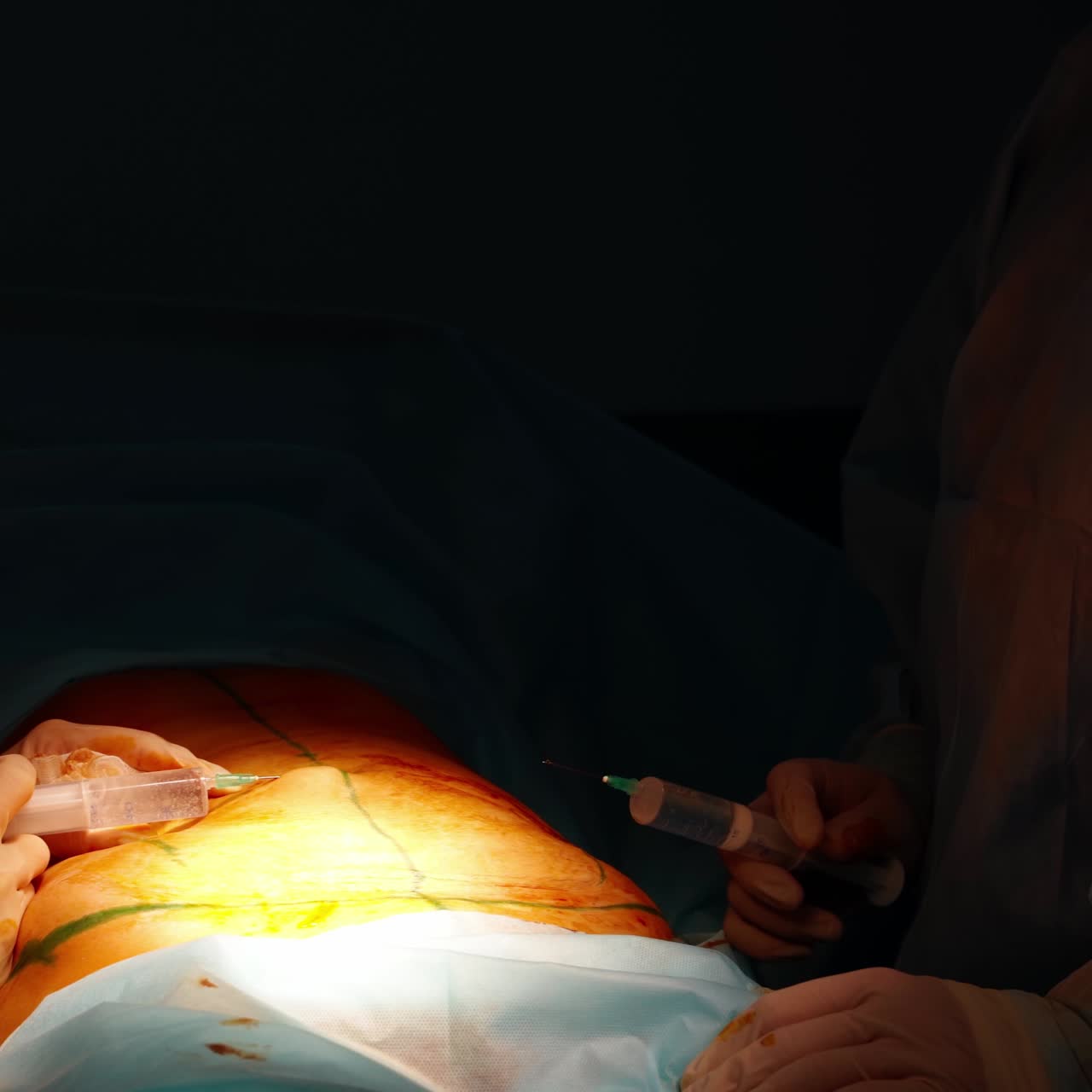 Abdominoplasty of the abdomen. Partial removal of fat and mucous tissues of the abdomen. The doctor cuts a laser surgical scalpel.