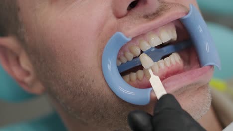 teeth whitening procedure. tooth whitening gel. dentist does the whitening procedure