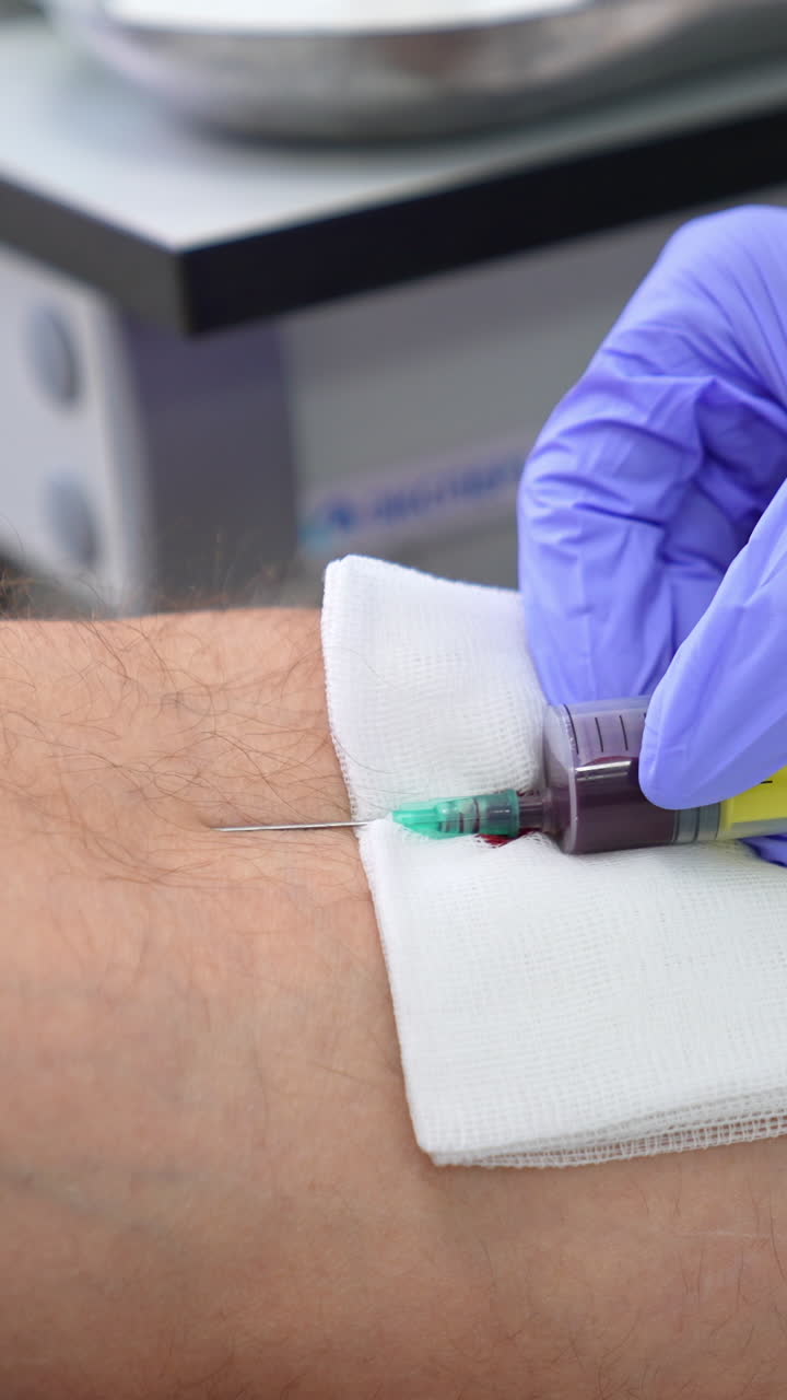 Taking blood for analysis in a hospital. Nurse in protective latex gloves carefully fills the big syringe with patient's blood. Close up. Vertical video