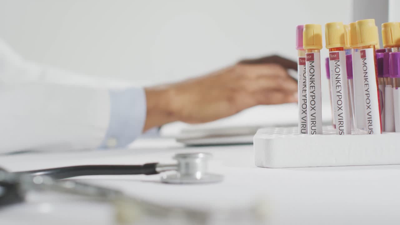 Vials with monkeypox virus and stethoscope over african american male doctor using laptop