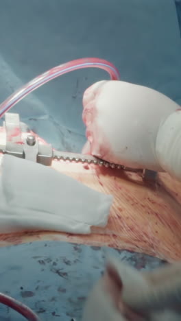 el cirujano utiliza un tubo torácico durante la cirugía. el médico utiliza equipos especializados para eliminar el aire y drenar el líquido después de realizar el procedimiento en la cavidad
