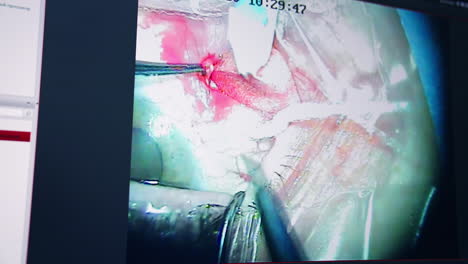 close up of operation of sight. doctor performing laser eye vision correction operation