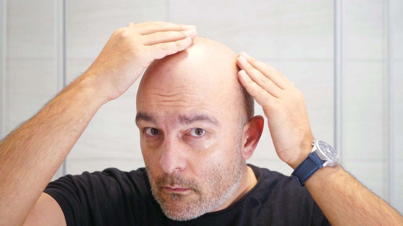 Middelaldrende mann sjekker hodebunnen sin i speilet.
