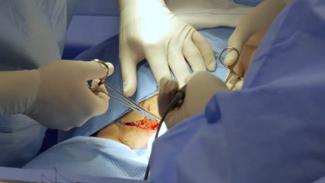 close-up of doctors performing a surgical operation on a patient's abdomen with visible incision and blood