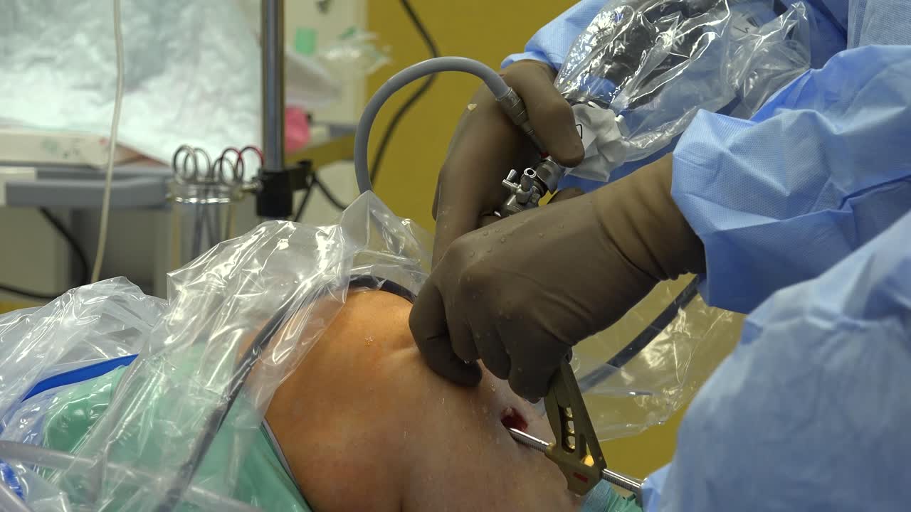 la reconstrucción del ligamento cruzado anterior es un reemplazo quirúrgico con injerto de tejido del ligamento cruzado anterior, ubicado en la rodilla, para restaurar su función después de una lesión.