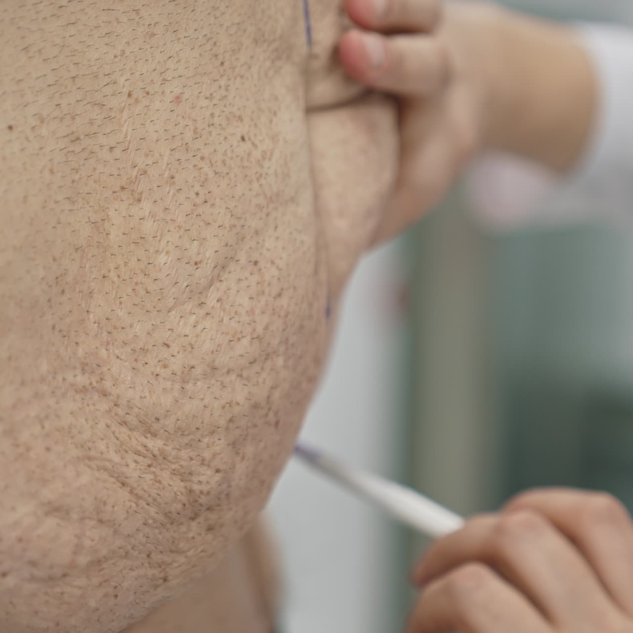 Close-up view of man's body with plastic surgery line markings. Abdominoplasty