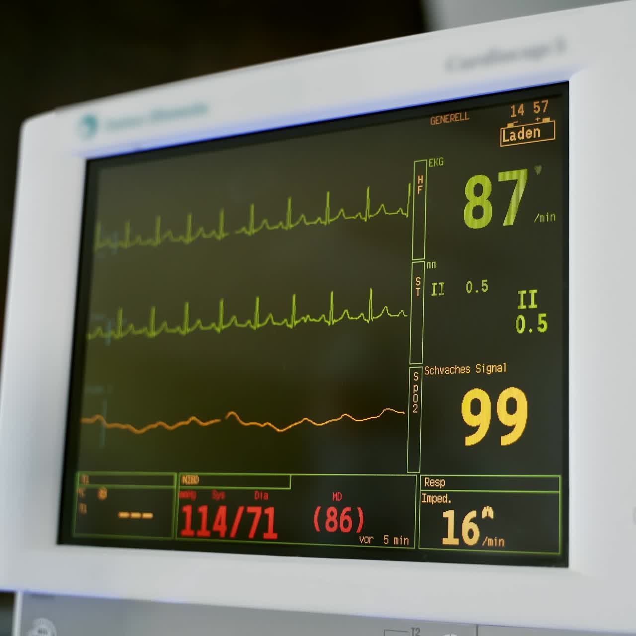 Monitor displays vital signs of a patient. Electrocardiogram on the monitor in operating room. Cardiac monitoring. Electrocardiography.
