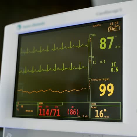 monitor displays vital signs of a patient. electrocardiogram on the monitor in operating room. cardiac monitoring. electrocardiography.