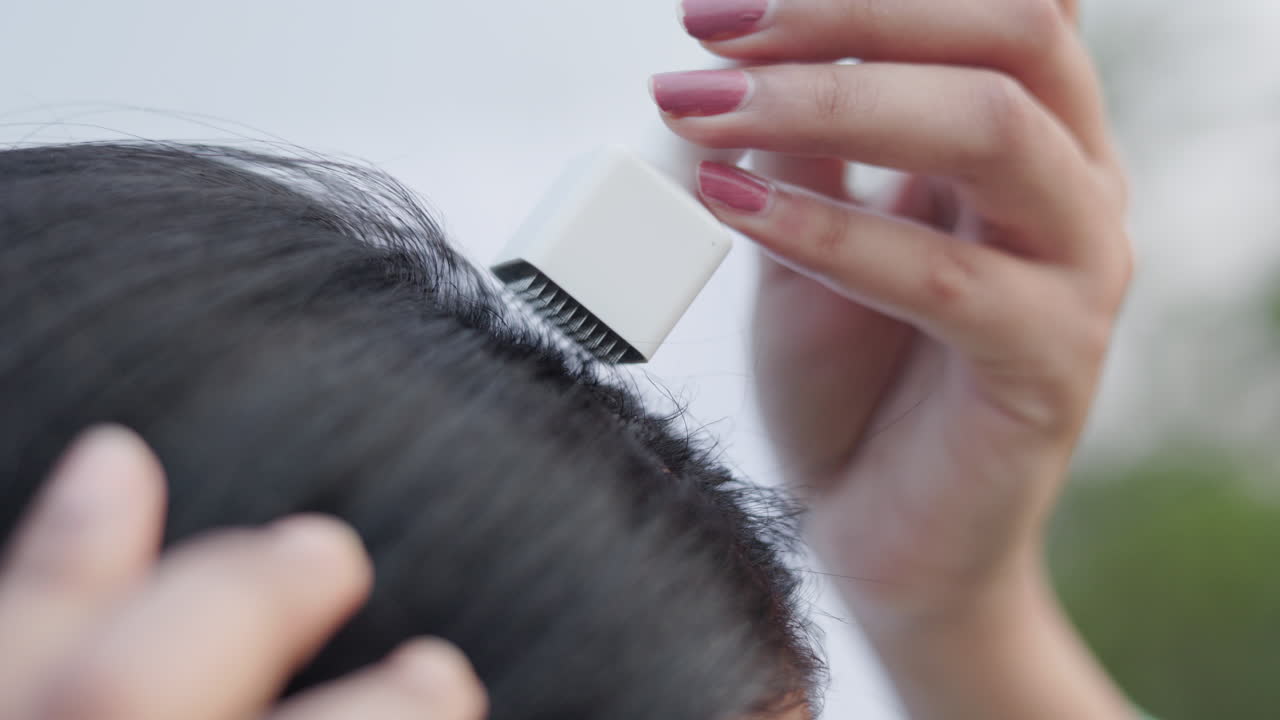 Collagen induction therapy, hairloss, a woman applying microneedling hairloss treatment for androgenic alopecia, close up shot.