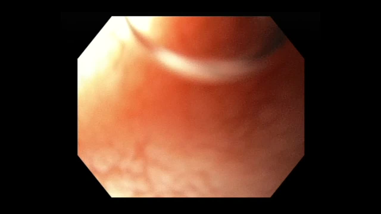 Anatomia di un esofago durante il tratto di gastroscopia. Macro