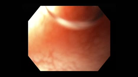 Anatomy-Of-An-Oesophagus-During-Gastroscopy--Tract.-macro