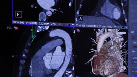 Resultados-De-Escaneo-Cardíaco,-Panorámica-De-La-Cámara-A-Través-Del-Monitor-De-La-Computadora---4k-Uhd