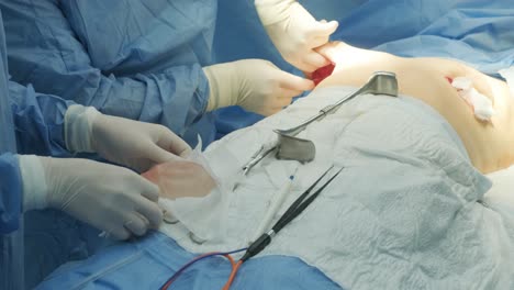 breast augmentation under the guidance surgeons team in surgical operating room