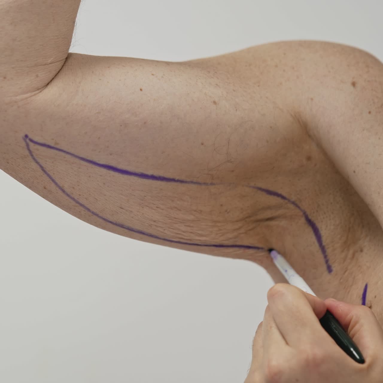 Surgeon preparing man for liposuction surgery. Plastic doctor draws markings on a body. Close-up. Body lifting concept