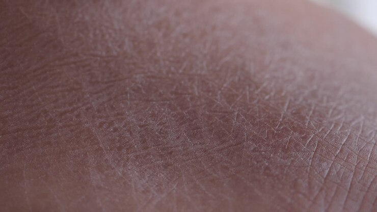 Close-up of Dry Skin on Hand