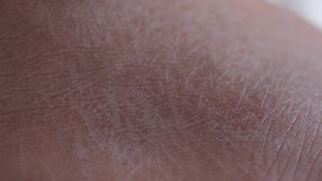 close-up of dry skin on hand