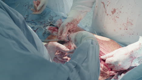 doctor hands tie thread closing incision. skilled surgeon tightens wire for holding halves of sternum together securely after surgery in clinic