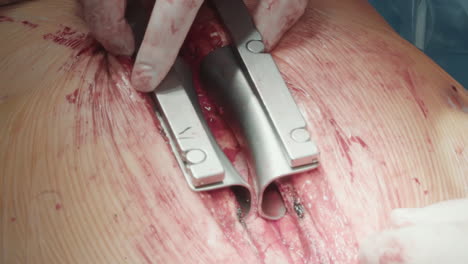 doctor uses dilator to prepare chest for artery operation. surgeon prepares coronary artery with tool ensuring effective bypass surgery and optimal patient outcomes in hospital