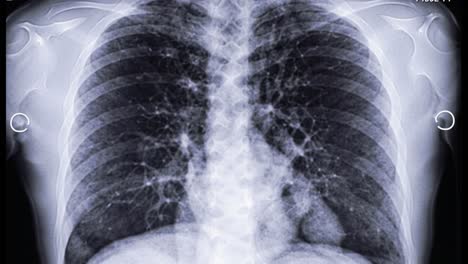 a chest x-ray displays the lungs and heart, showing various structures and potential conditions. the image provides insights during a recent medical assessment for respiratory health.