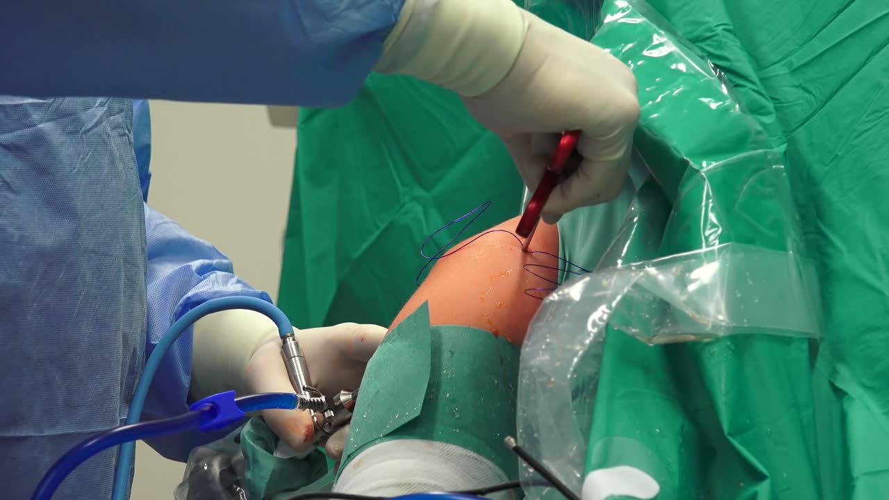 la cirugía del hombro es un medio para tratar los hombros lesionados