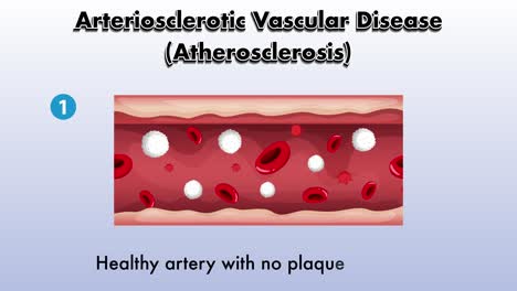 illustration of atherosclerosis development stages