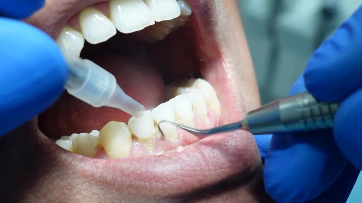 Primo piano delle mani di un dentista con guanti blu che utilizza uno strumento ablatore per pulire la placca dai denti
