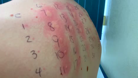 Allergy-skin-test-on-teen-boy's-back-with-inflammed-allergic-reactions,-medical-doctor's-office,-4k-dolly-in--handheld