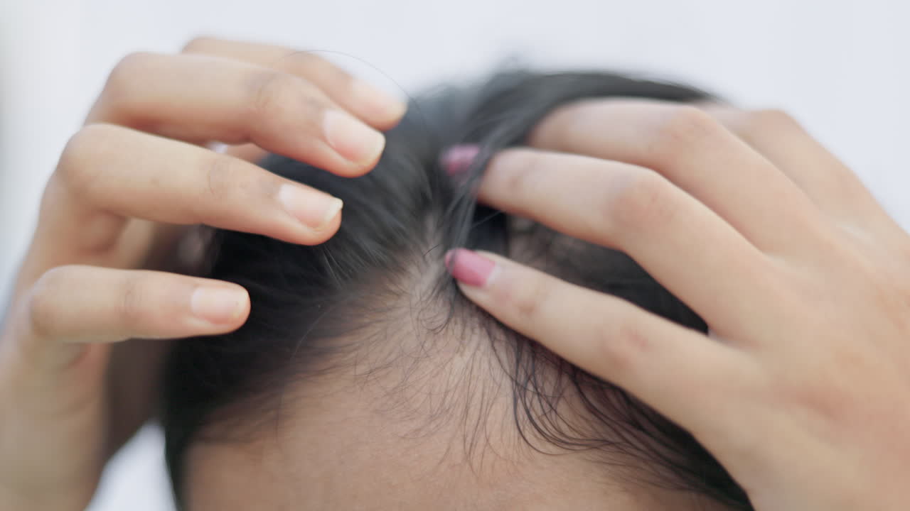 A young woman showing her hair loss scalp, androgenic alopecia, female pattern baldness, India.