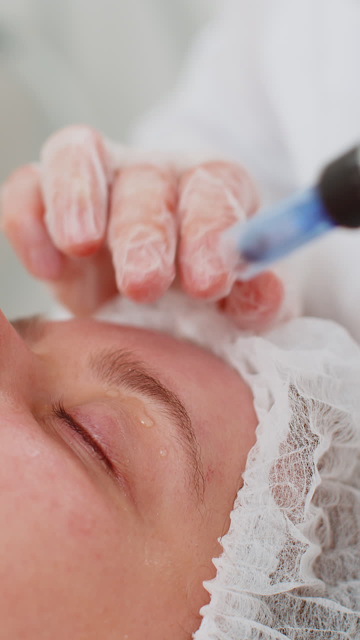 Cosmetologist doing peeling procedure woman skin regeneration dermapen microneedling dermastamp