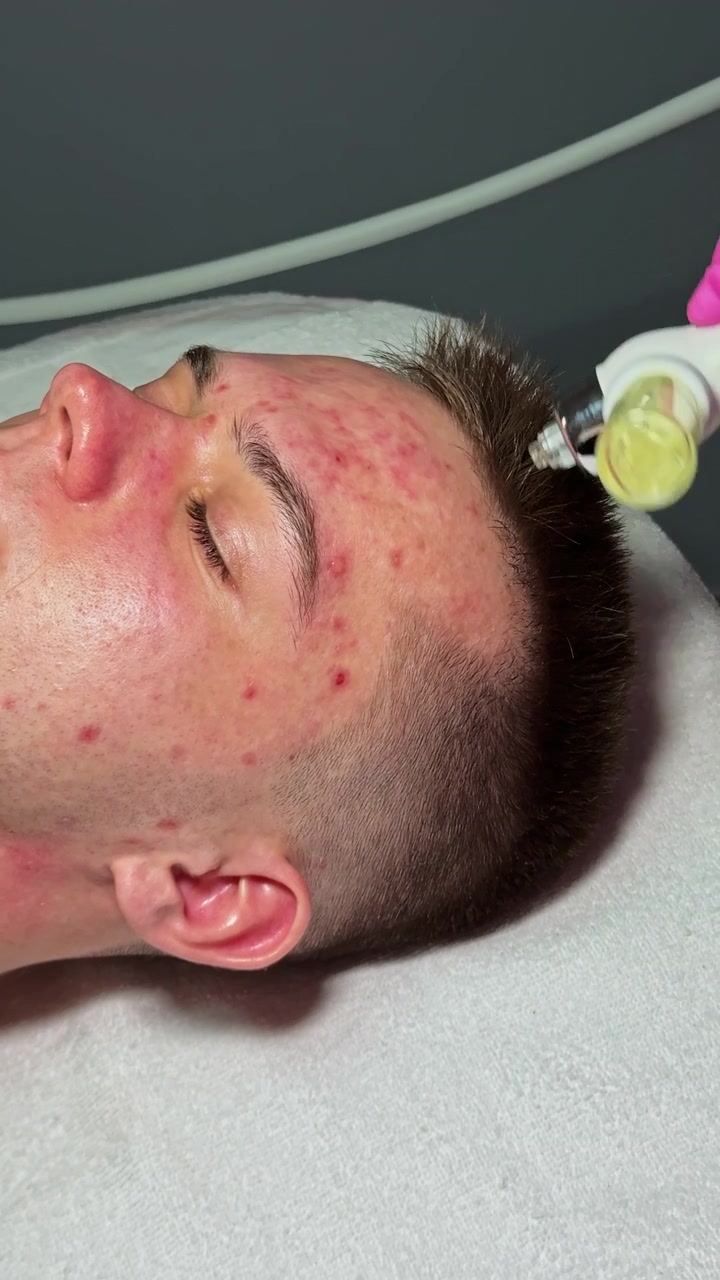 Sessione di trattamento della pelle con un cliente in uno studio di cura della pelle durante il giorno, focalizzata sulla cura dell'acne utilizzando un dispositivo di pulizia.