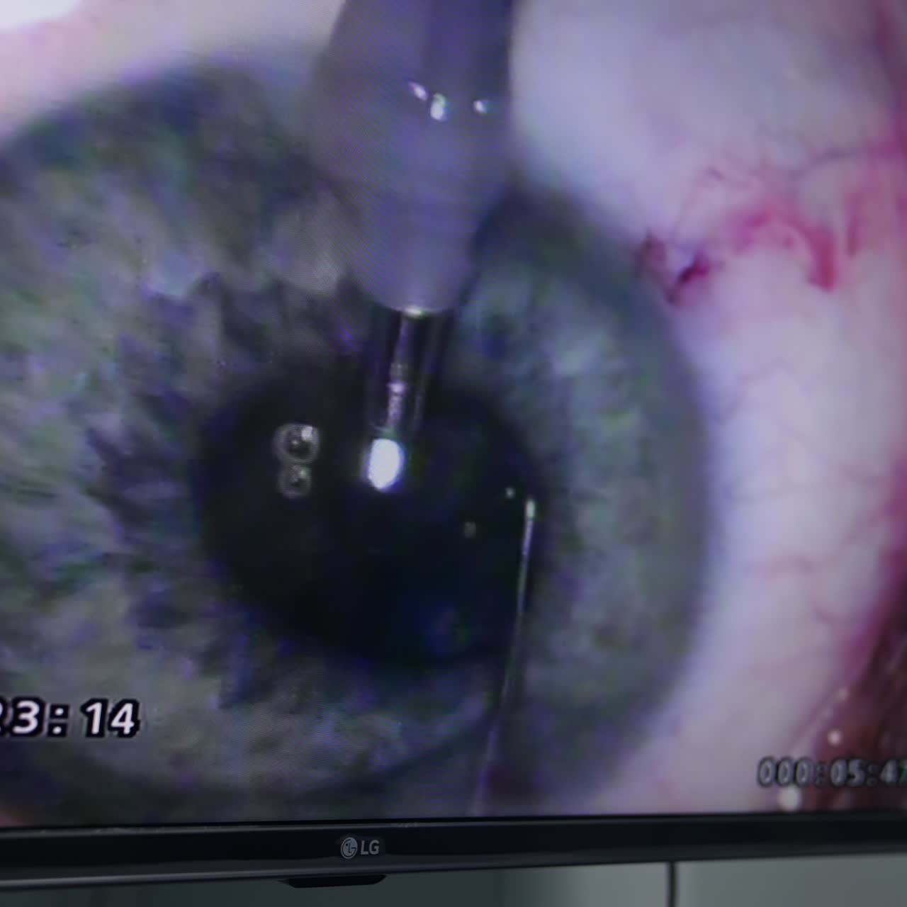 Screen in surgery room showing the operated eye. Thin needle and tool being applied to eyeball of a patient. Close up