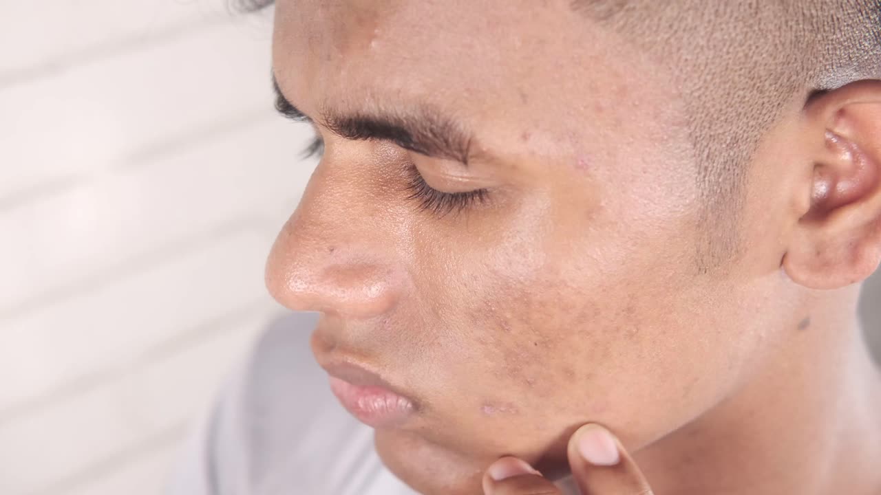 hombre con cicatrices de acné