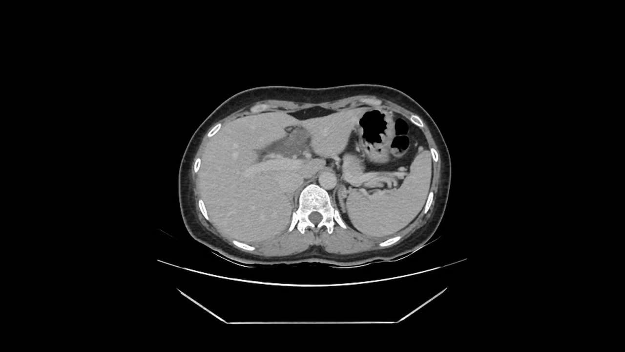 La TAC rivela appendicite e calcoli biliari in un paziente, in un ambiente diagnostico ospedaliero di imaging medico.
