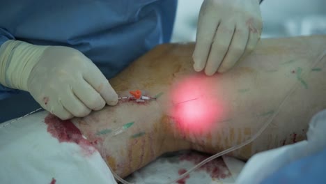 aplicación de bioglue en el tratamiento quirúrgico de la úlcera de la pierna