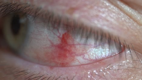 primer plano del ojo de la mujer con manchas rojas de sangre y moretones - lesión ocular y condición médica