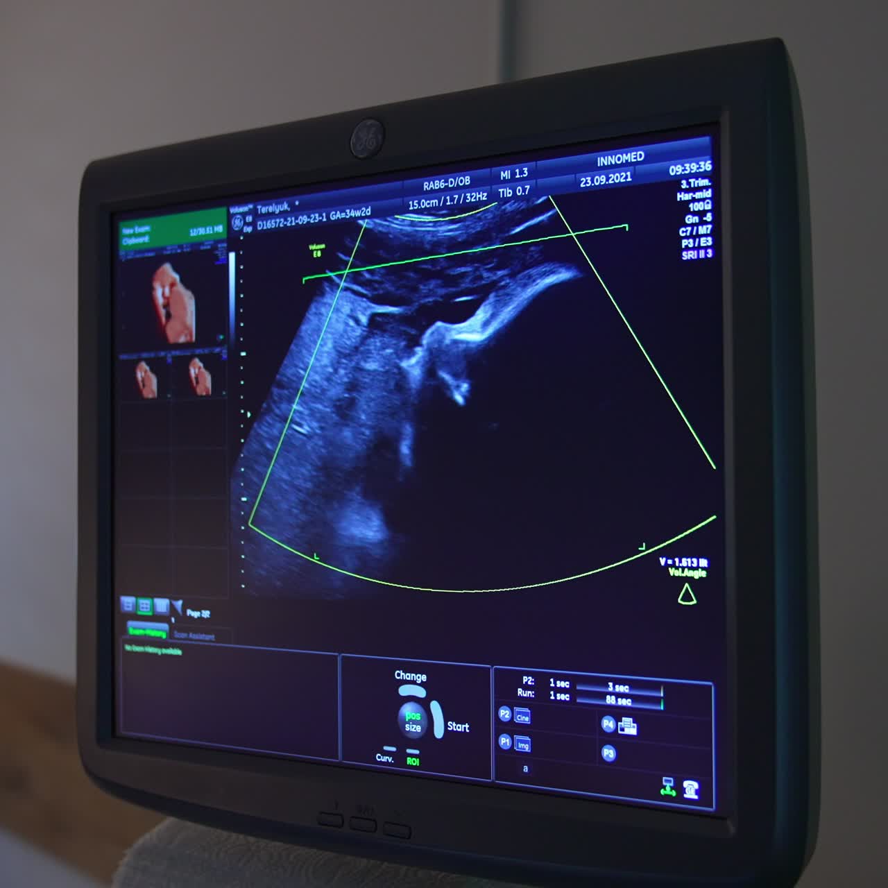 Little baby seen on the screen in mother's womb. Blue monitor showing the child development parameters